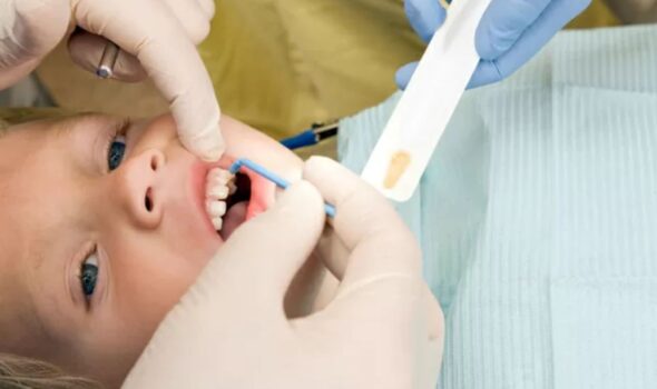 Fluoride Treatment by Dr Anukriti Gupta