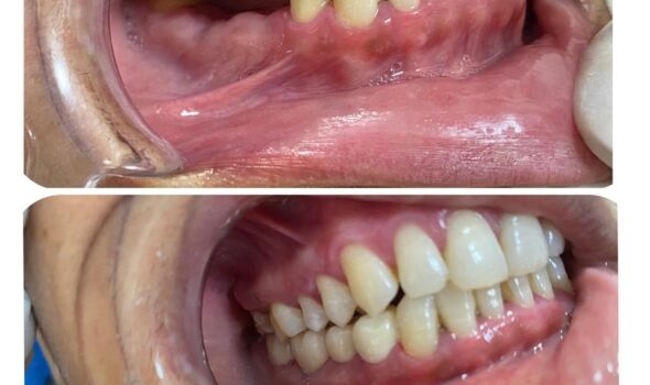 Dental Treatment Before and After
