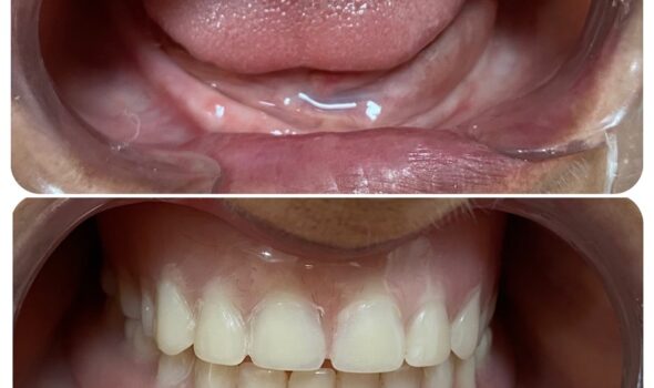 Dental Treatment Before and After