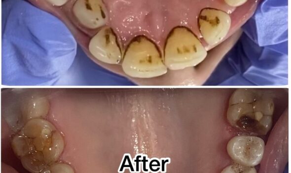 Polishing Treatment Before and After