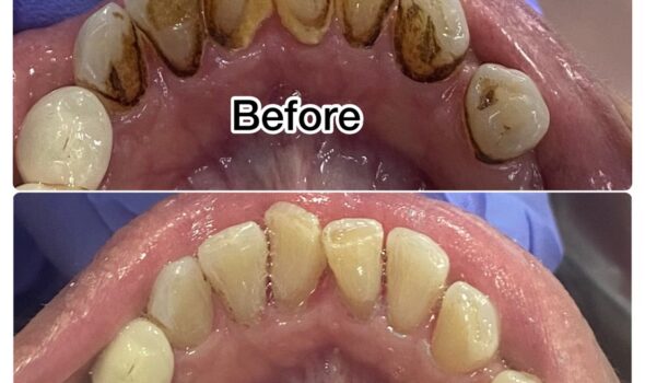 Polishing Treatment Before and After