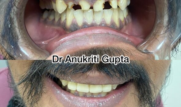 Dental Treatment Before and After