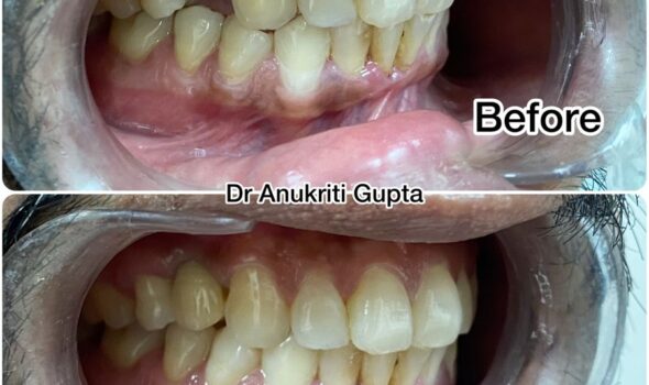 Dental Treatment Before and After