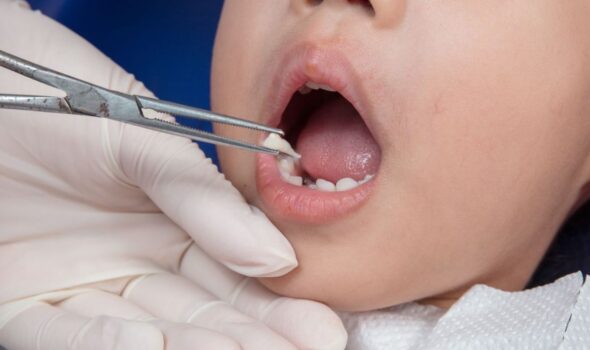 kids painless tooth extraction