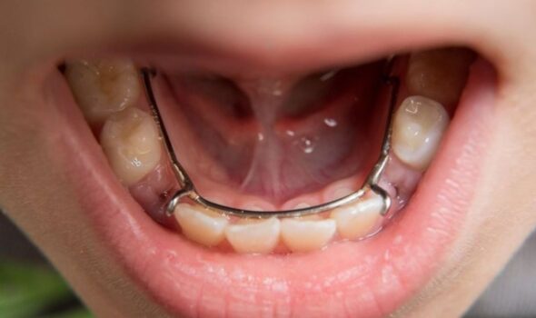 pediatric space maintainer