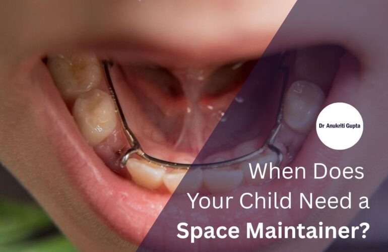 Space Maintainers in Pediatric Dentistry